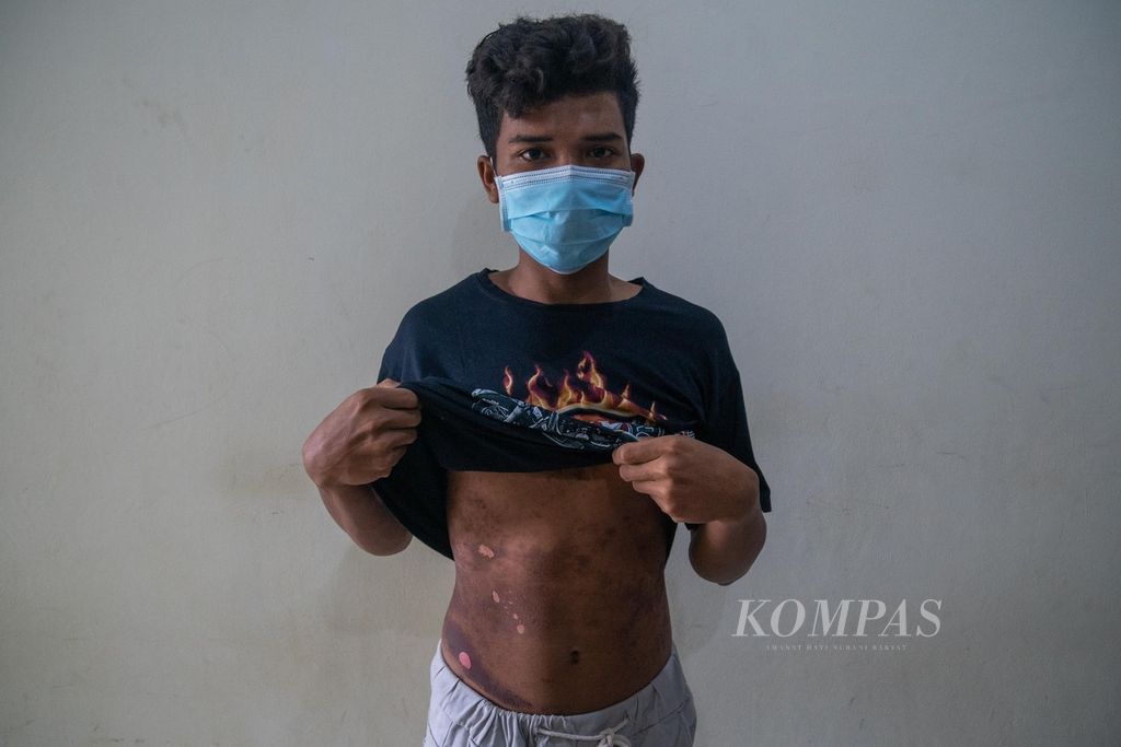 Zohir (21) menunjukkan luka di perut saat ditemui di rumah singgah Badan Pelindungan Pekerja Migran Indonesia di Batam, Kepulauan Riau, Selasa (21/6/2022). Luka di perut akibat terlalu lama memeluk jeriken untuk menyelamatkan diri saat perahu pengangkut 30 pekerja migran tanpa dokumen yang ia tumpangi tenggelam di perairan Nongsa, Batam, Kamis (16/7/2022).