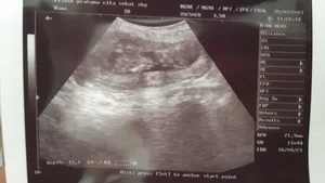 Egg Freezing, Maintaining Quality for Longer Time