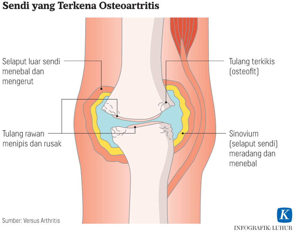 https://assetd.kompas.id/OIUK-pi1wImlY0iJGGG0L_nQC2I=/1024x809/https%3A%2F%2Fasset.kgnewsroom.com%2Fphoto%2Fpre%2F2021%2F01%2F12%2F20210112-LHR-Sendi-osteoartritis-mumed_1610450201_png.png