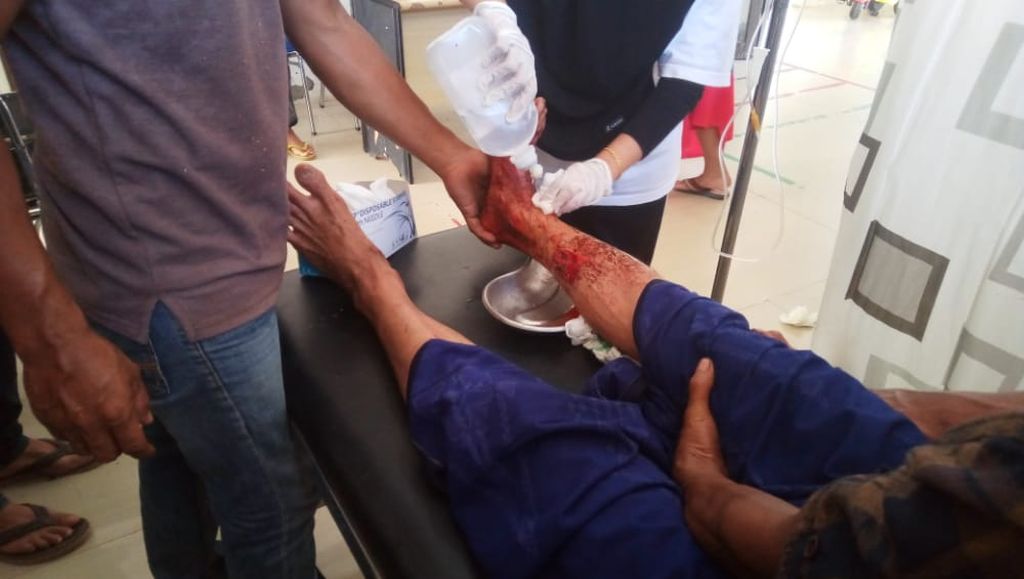 Seorang petani, Muhajir (47), warga Desa Seuleukat, Kecamatan Trumon Timur, Kabupaten Aceh Selatan, Aceh, mengalami luka pada kaki kanan karena diterkam harimau liar, Sabtu (21/5/2022). Konflik antara satwa dan manusia membuat warga tidak tenang berkebun dan kehidupan satwa terancam