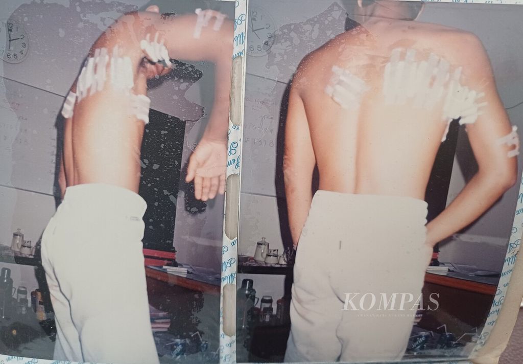 Seorang anggota Kopassus, saat itu berpangkat prajurit dua, memperlihatkan luka-luka akibat penganiayaan oleh kelompok Fretelin di Suai, Timor Timur, Agustus 1998. Dia adalah satu-satunya anggota Kopassus yang selamat dari delapan anggota Kopassus, saat dalam perjalanan dari Dili ke Suai. Ia berpura-pura mati setelah tertembak dan disabet senjata tajam di dalam truk. Tubuhnya terimpit anggota Kopassus lain yang gugur saat itu, Juli 1996. 